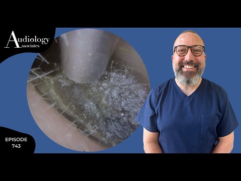 HARD AS STONE EAR WAX PLUG REMOVAL - EP743