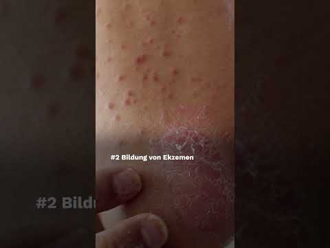 Scabies: These are typical signs #shorts