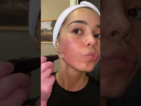 Microneedling Pen for Acne Scar Repair