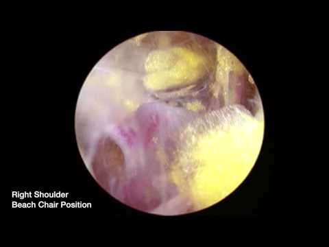 Arthroscopic Suprascapular Nerve Release