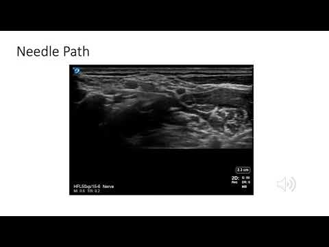 Ultrasound-Guided Interscalene Brachial Plexus Nerve Block by Amy Achiko, MD Candidate Class of 2022