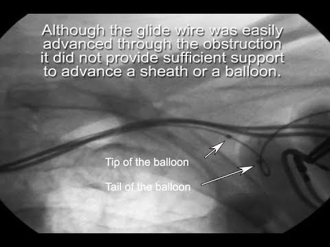 How to use a braided hydrophilic catheter to exchange a glide wire for an Amplatz extra support wire
