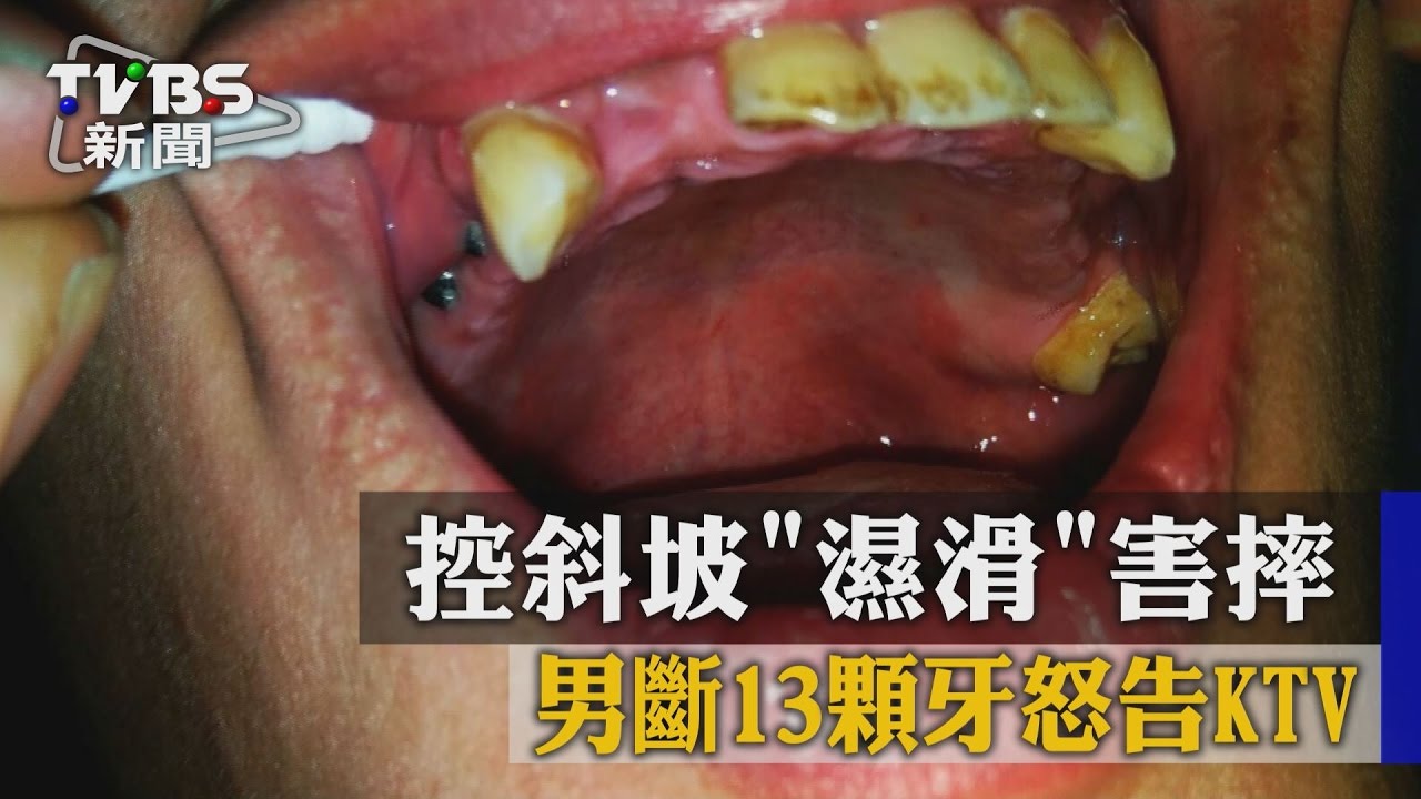 控斜坡「濕滑」害摔 男斷13顆牙怒告KTV