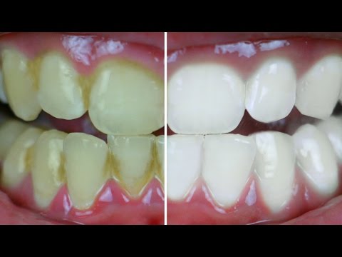 Teeth Whitening At Home In 2 Minutes - पाएं सफेद चमकदार दांत | Anaysa
