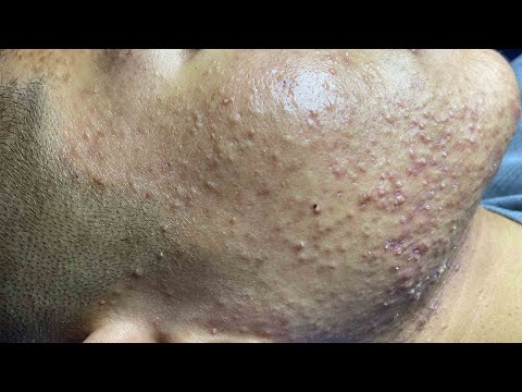 Acne Treatment For "Hung" (P4) | Điều Trị Mụn Cho Hùng (P4) -  SacDepSpa#189