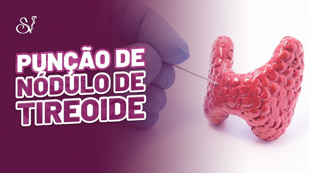 Quando fazer punção de um nódulo de tireoide?