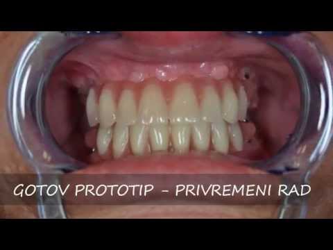 download lagu mp3 mp4 Implantati All On 4 Cijena, download lagu Implantati All On 4 Cijena gratis, unduh video klip Implantati All On 4 Cijena