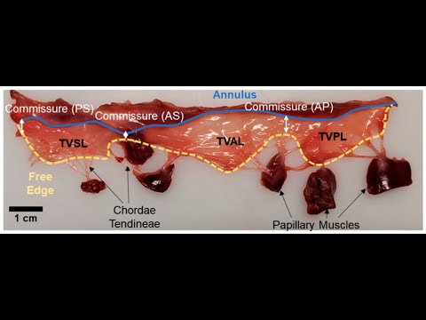 Subvalvular apparatus of tricuspidal valve