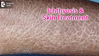 What is Ichthyosis? How to Treat my Skin?| Fish like scales On Skin-Dr.Rasya Dixit | Doctors