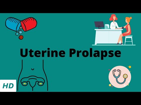 Uterine Prolapse, Causes, Signs and Symptoms, Diagnosis and Treatment.