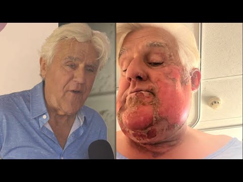 Jay Leno Gives Health Update 2 Years After Burn and Motorcycle Accidents