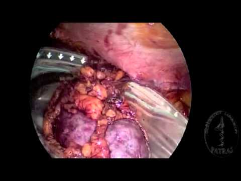 Transvaginal Nephrectomy - Specimen Extraction