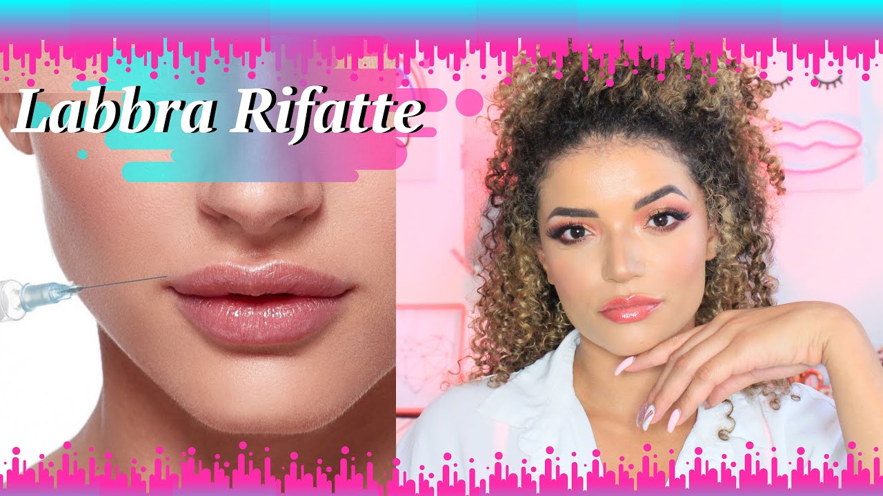 LA MIA ESPERIENZA CON IL FILLER PRIMA E DOPO 1 ANNO #VANITOSADOPOI30