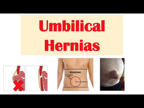 Umbilical Hernia | Belly Button Hernia | Risk Factors, Signs and Symptoms, Diagnosis, Treatment