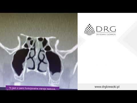 Tomografia komputerowa zatok