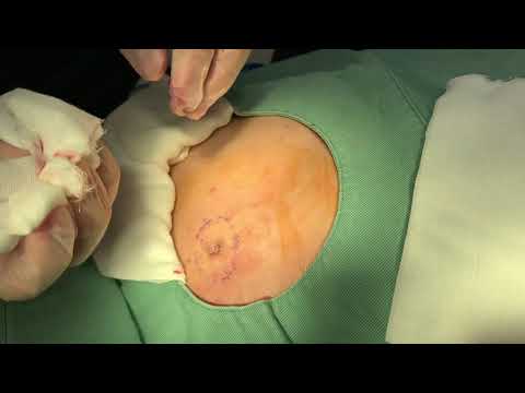 Large Back Cyst Removal 2026