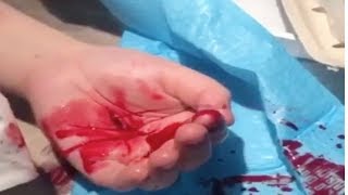 Child Accidently Stabs Hand (After Action Report)