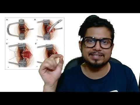 Laser surgery for piles fissure and fistula Laser treatment for piles fissure and fistula benefit