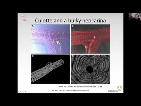 Provisional Cullotte Stenting - Dr Vlad Dzavik