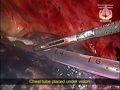 Segmentectomy For Giant Bulla