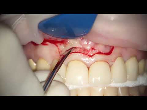 Re-surgery central incisor