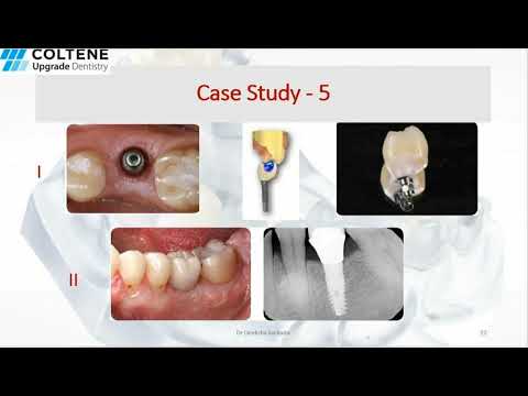 Brilliant Crios: A reinforced Composite milling block for aesthetic permanent restorations