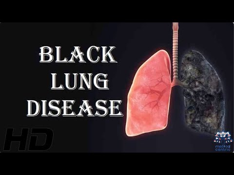 Nasal and Paranasal Tumors Causes Signs and Symptoms Diagnosis and Treatment