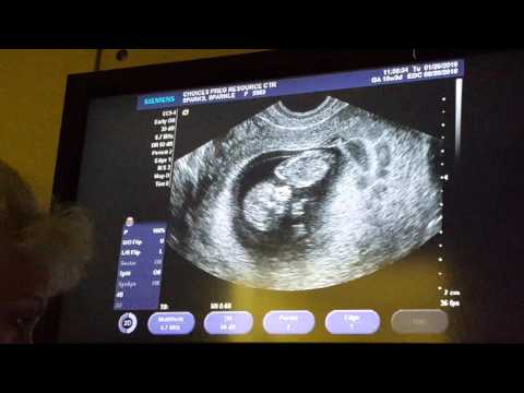My Ultrasound at 10 Weeks Pregnant | Baby Hardnett👣2016