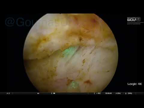 Enblock hybrid thulep unedited