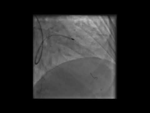 Rotational Atherectomy via Radial Artery Access: Case 1