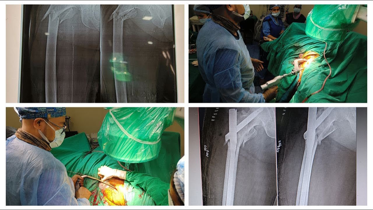 Femur Fracture Surgery Fixation By TFN