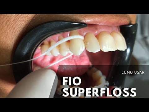 How to Use Oral-B Superfloss | Dr. Victor Hugo Almeida
