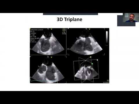 Evaluation of atrial septal defects and guidance for transcatheter closure