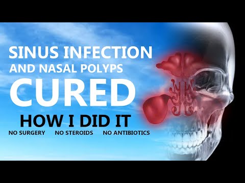 How I cured my chronic sinus infection and nasal polyps - without surgery, steroids or antibiotics