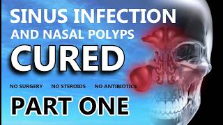 How I cured my chronic sinus infection and nasal polyps - without surgery, steroids or antibiotics