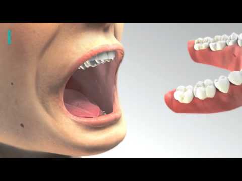 Langzeitstabiler Zahnersatz mit Mini Implantaten   Wie es funktioniert