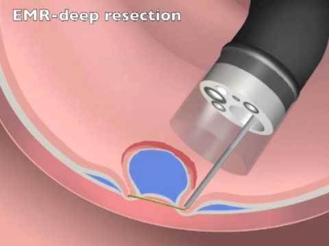 Endoskopowa resekcja śluzówkowa - głębokie wycięcie
