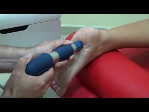 Terapia falą uderzeniową - Ostroga piętowa dolna