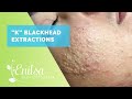 Blackheads, Whiteheads Extractions on 