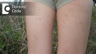 How to manage inner thigh rashes in teenagers? - Dr. Urmila Nischal