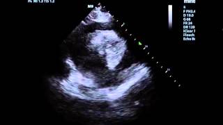 SOB in a patient with cancer -- Cardiac Tamponade