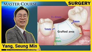 Download lagu [Master Course Season2 - SURGERY] Treatment Modality Based on Bone Defects - GBR mp3