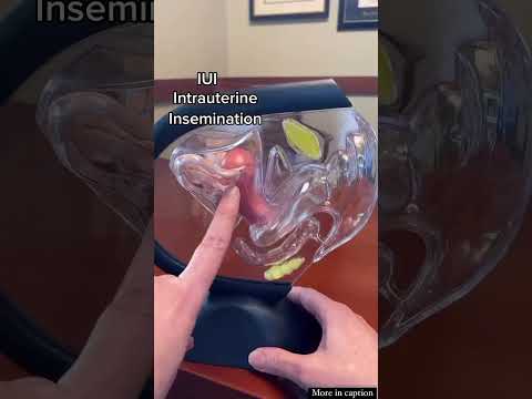 #iui #infertility #shorts