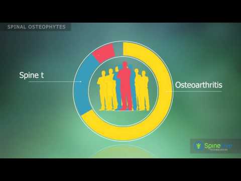 Salbe zur Behandlung von Osteoarthritis des Knies Knieklammern für Wo zu kaufen
