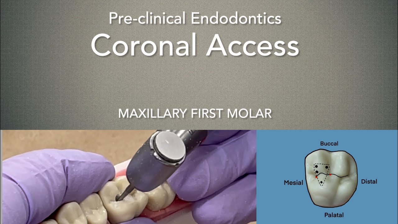 Coronal Access (Maxillary First Molar)