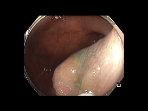 Pólipo de colon en un paciente con antecedentes de cáncer de colon
