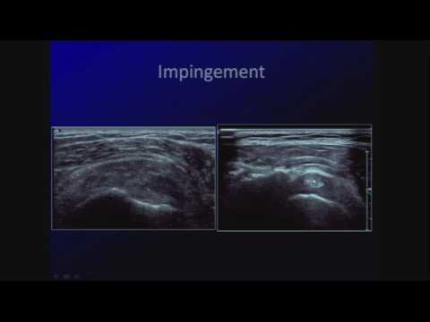 Sonography of Common Shoulder and Elbow Pathology