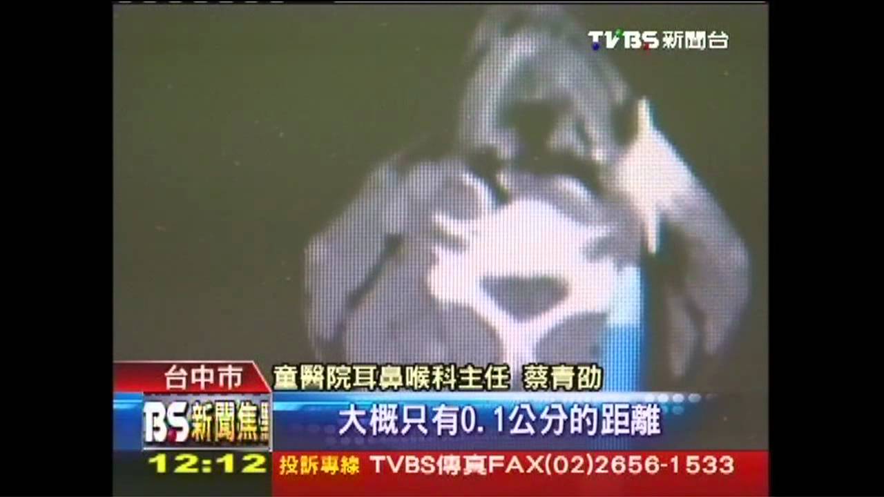 驚險!誤觸釘槍長釘穿頸 距動脈0.1公分