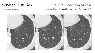 Case of the Day - 122 - 2025 10 29 - Identifying Mucus Plugs in Asthmatics - Relevant?