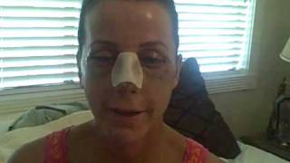 Facial Plastic Surgery: Recovery Day 7